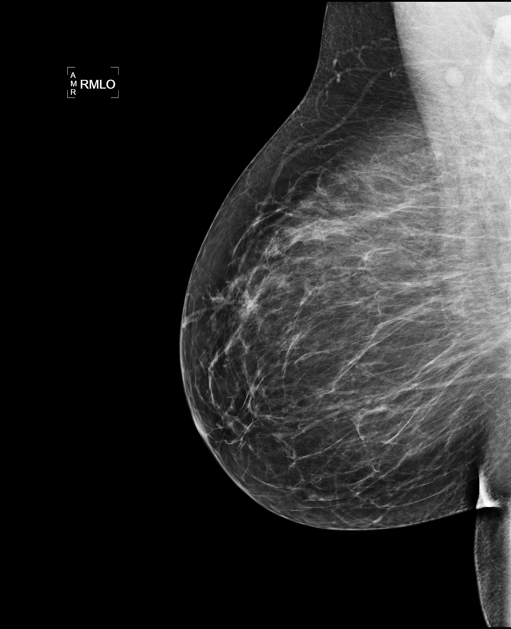 Predispozitia la cancerul mamar
