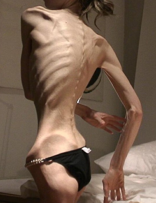 anorexia remediați pierderea în greutate