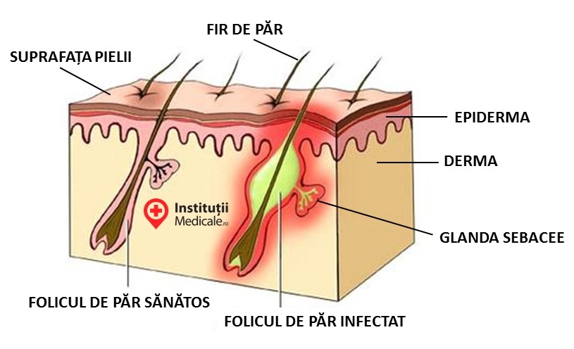 Spironolactona acnee pareri